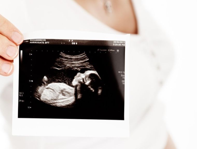 Ein Symbolfoto mit einer Schwangeren und dem Ultraschallbild einer Frau 